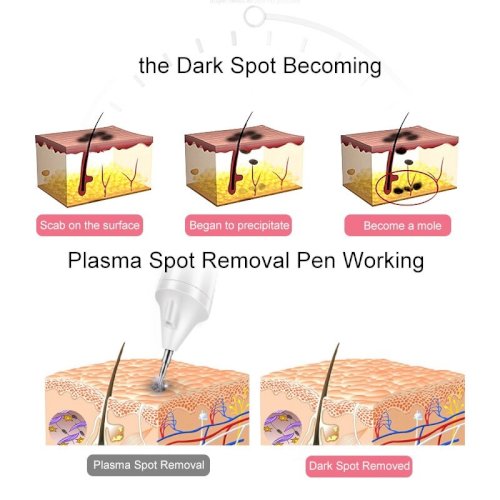 K-SKIN Laser Freckle Removal Dark Spot Remover Mole Removal Skin Care KD306